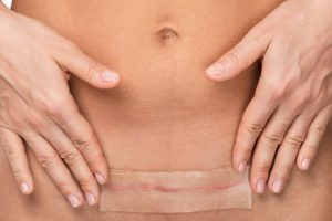 Terapia rozejścia mięśni prostych u kobiet po porodzie